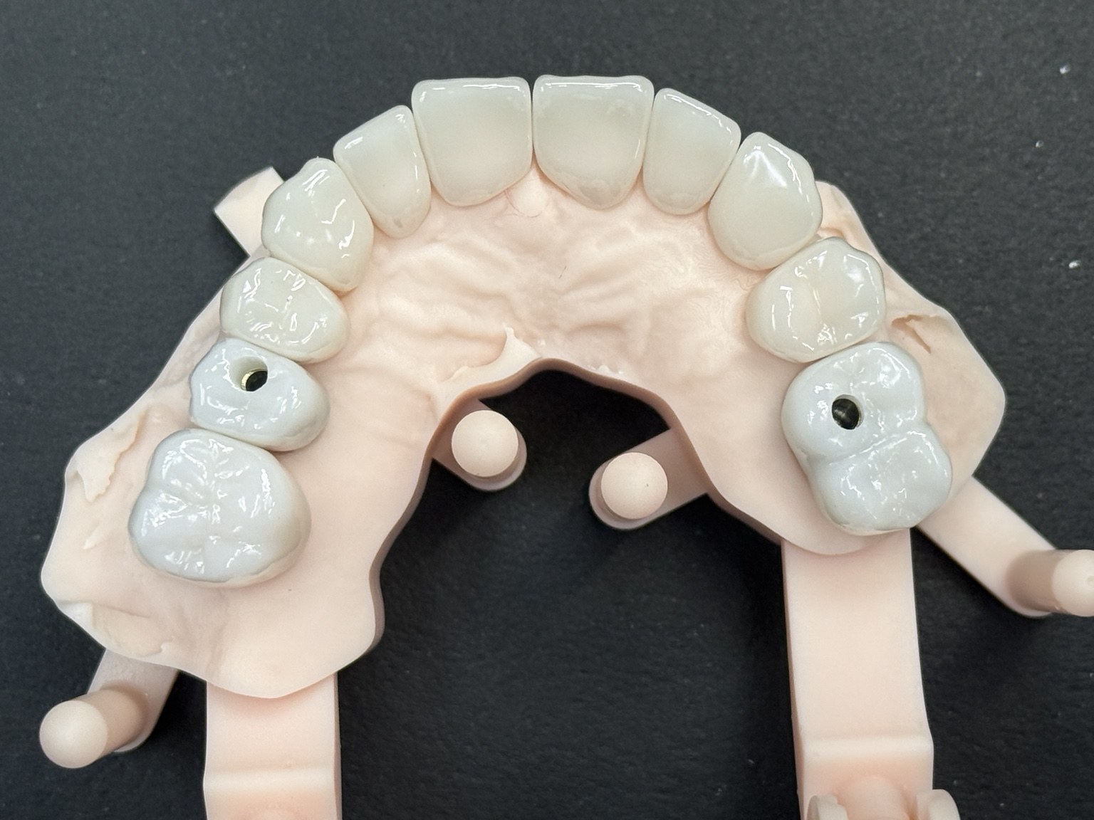Implant Restorative Case