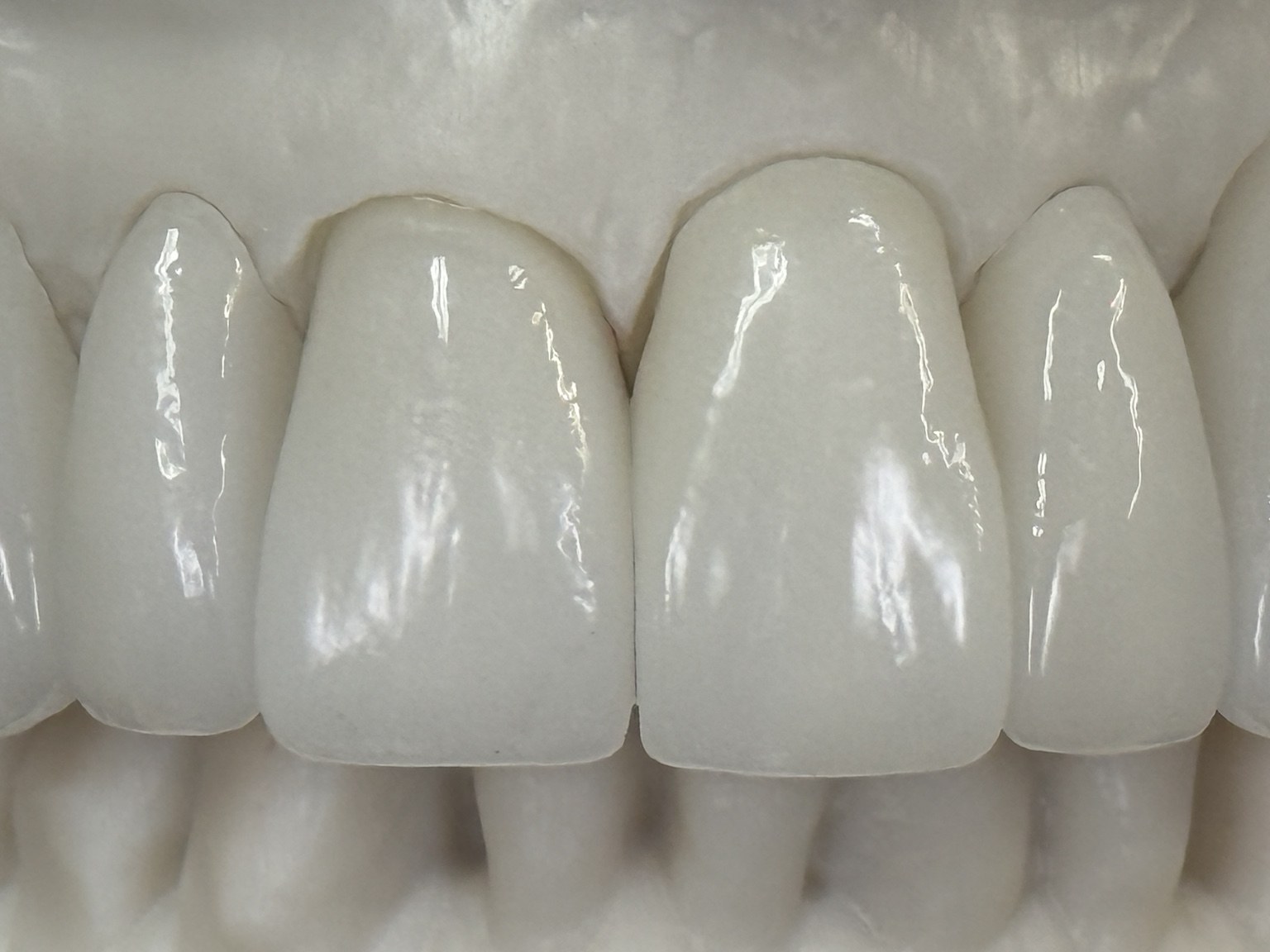 Anterior Restorative Study