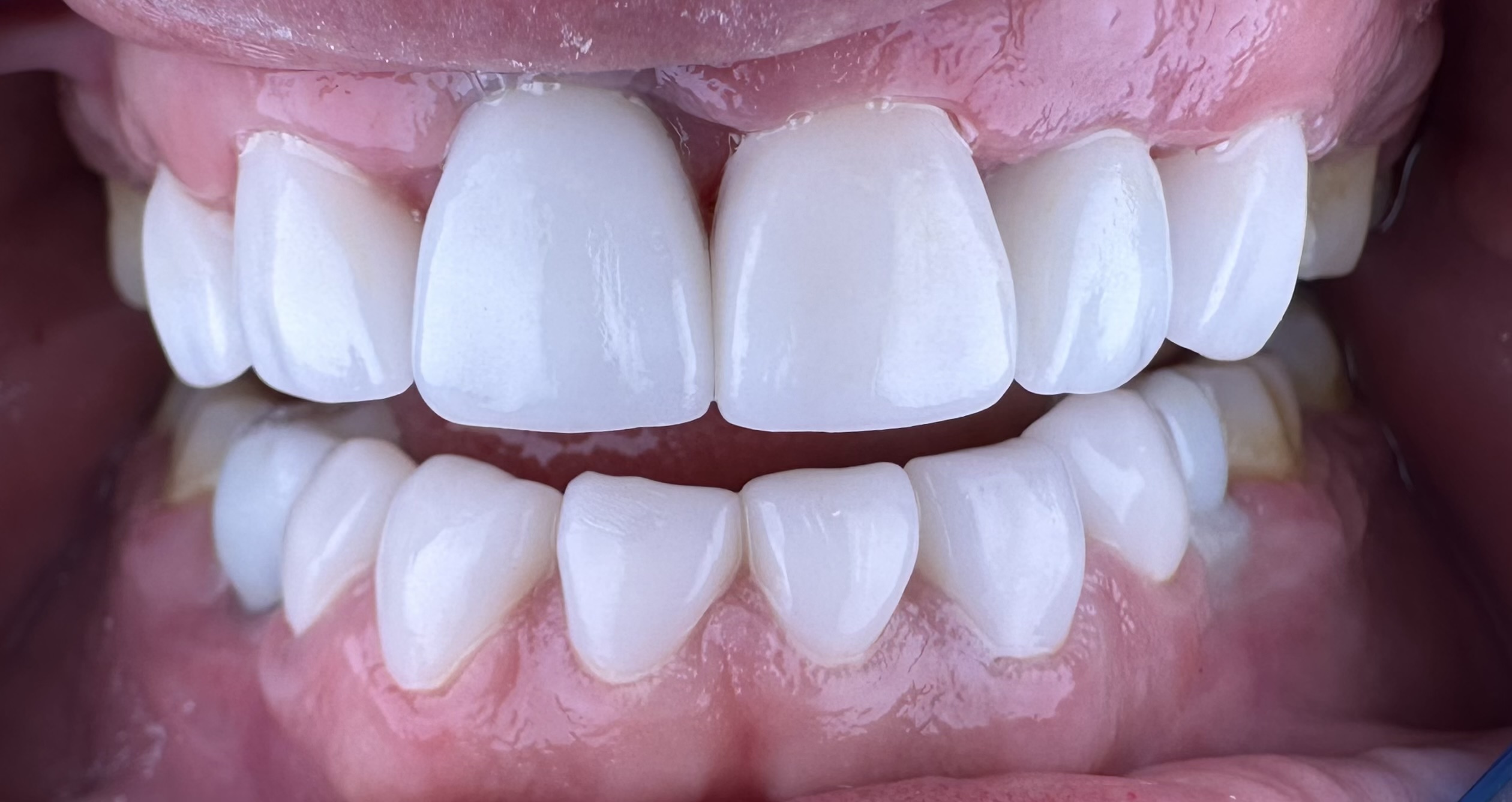 Esthetic & ceramic restorations.