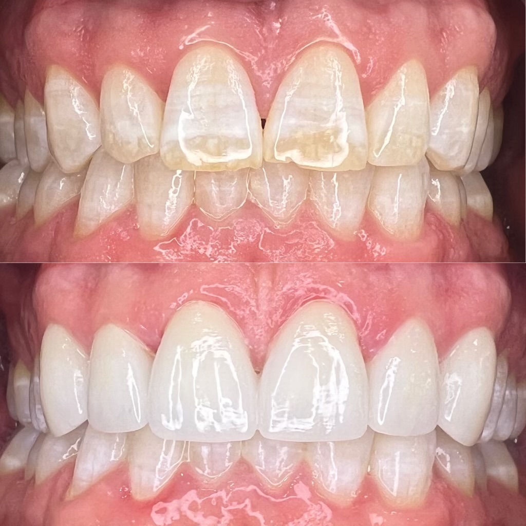 Before and After Esthetic Restorations