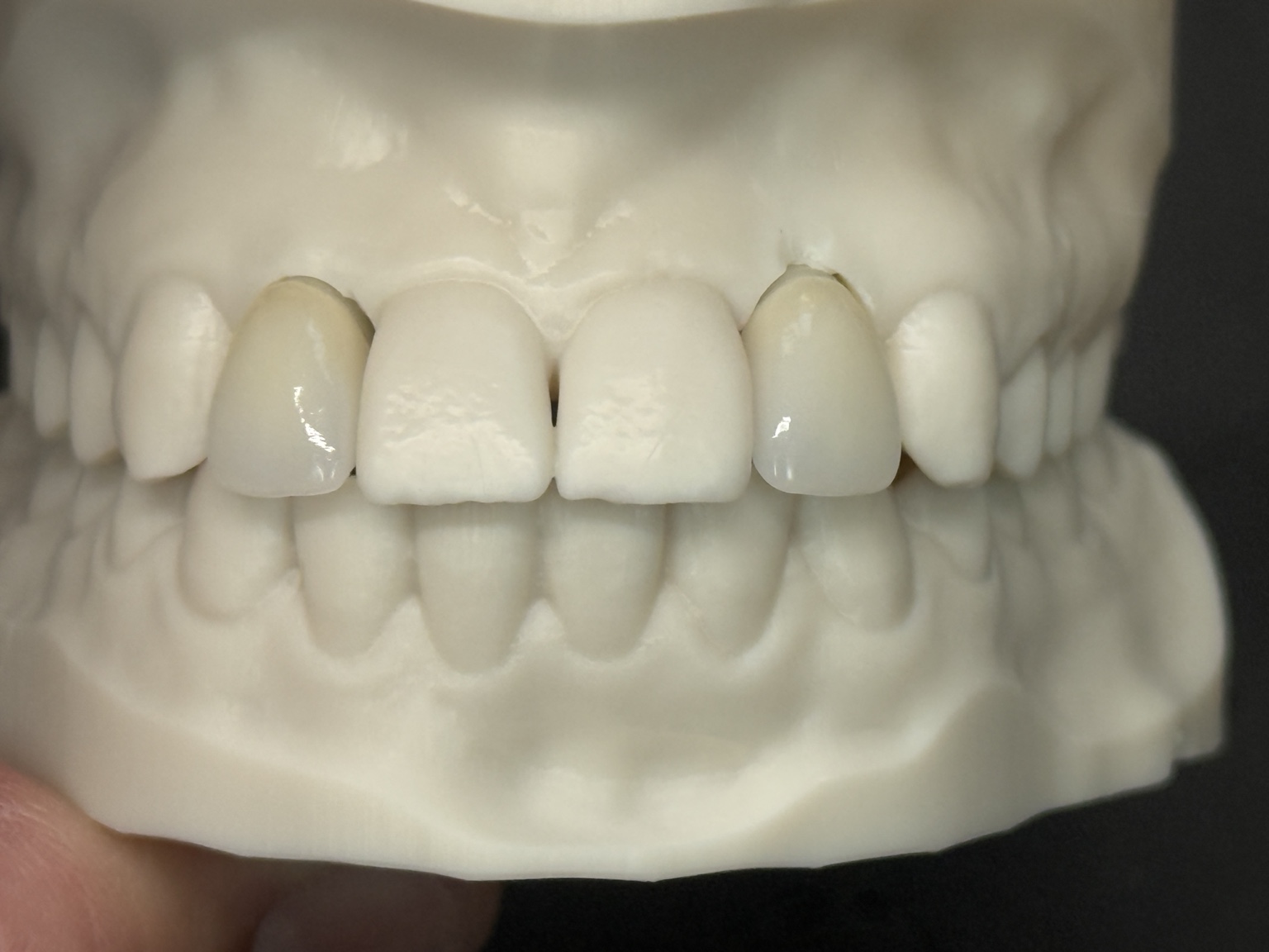 Implant restorations with a collaborative workflow.
